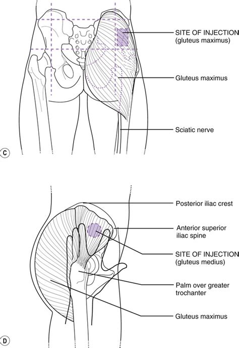 Im Injection Sites Guide Gluteal Muscle Mastery Orientation Hub Im Injection Sites Guide Gluteal Muscle Mastery Orientation Hub