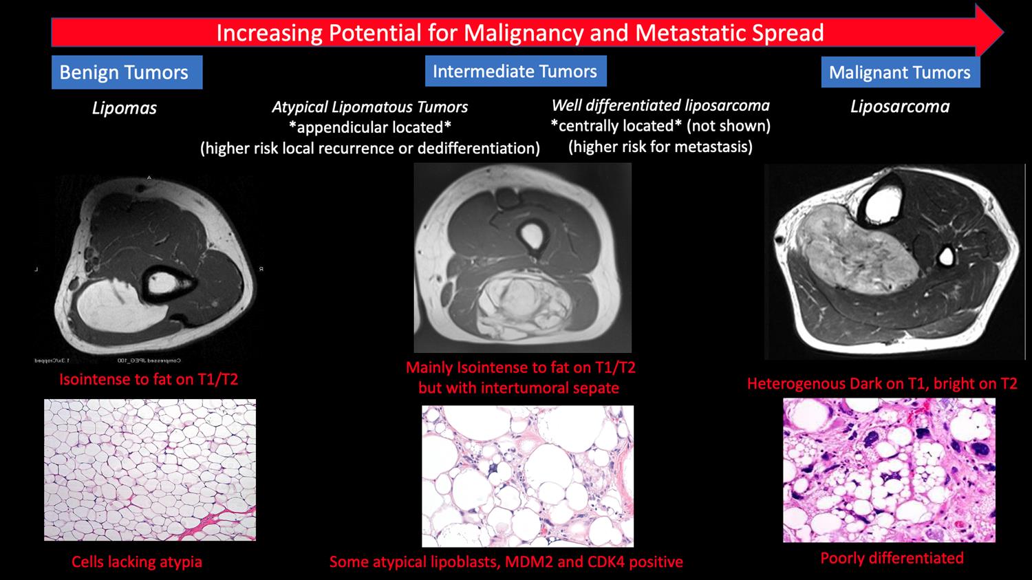 Images Of Fatty Tumors