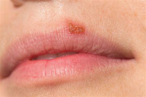 Images Of Herpes On Lips Pictures Photos