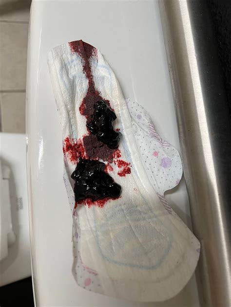 Images Of Miscarriage Blood Clots