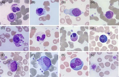 Immature Granulocytes Blood Film Medschool