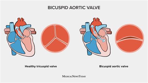 Implications Of Bicuspid Aortic Valve Disease And Aortic Stenosis Implications Of Bicuspid Aortic Valve Disease And Aortic Stenosis