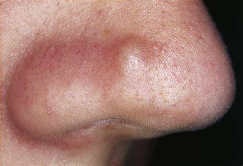 Ingrown Hair In Nose Pictures Pimple Symptoms Pluck Infection On