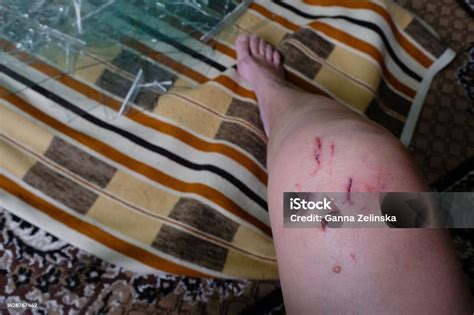 Injured Female Leg On A Background Of Broken Glass Cut Wounds And Blood Injured Female Leg On A Background Of Broken Glass Cut Wounds And Blood