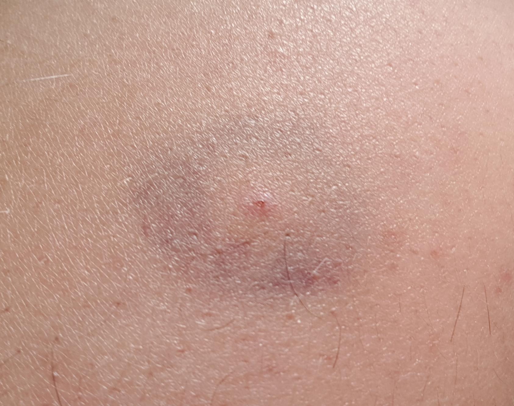 Insect Bite On Arm With Bruise Circle Around Don T Remember Being