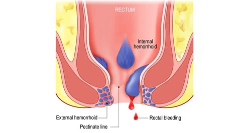 Internal Vs External Hemorrhoids Recognizing The Differences And Internal Vs External Hemorrhoids Recognizing The Differences And