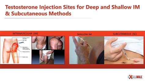Intramuscular Injection Sites Testosterone