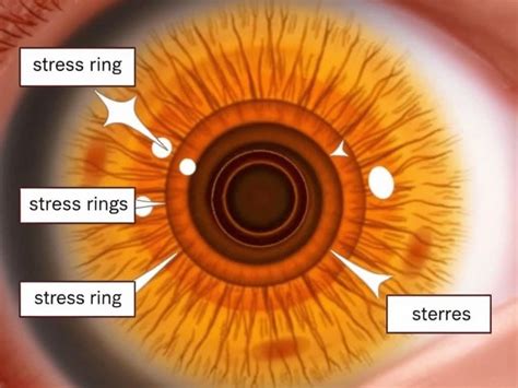 Iridology Stress Rings What Why And The Mean Iriscope Iridology