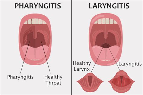 Is Pharyngitis Contagious