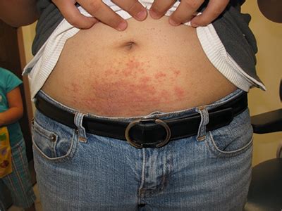 Itchy Rash On Stomach