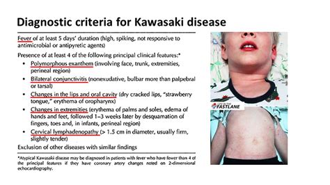 Kawasaki Disease Criteria