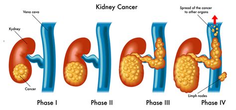 Kidney Cancer Survival Rates