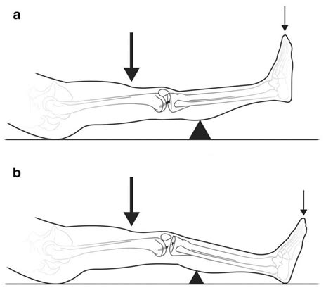 Lachman Test: Understanding Knee Stability and Injury Prevention