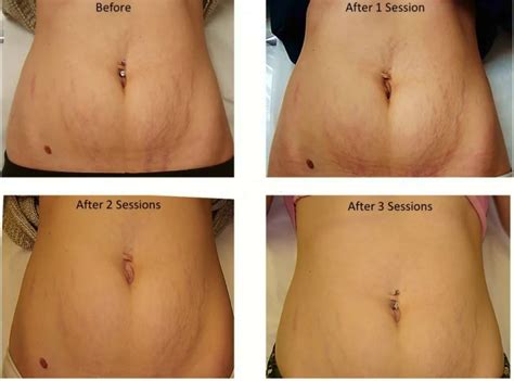 Laser Stretch Mark Removal Doctor S Review Before After Laser Stretch Mark Removal Doctor S Review Before After