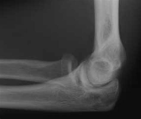 Lateral View Of The Left Elbow Demonstrating A Moderate Joint Effusion