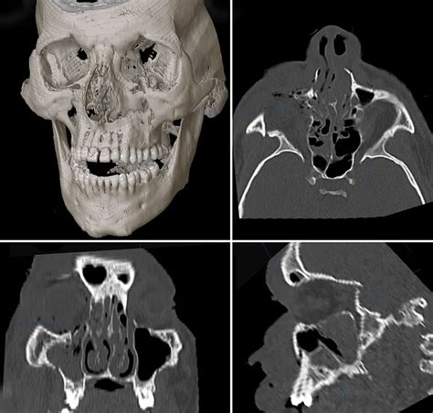 Le Fort Fractures American Academy Of Ophthalmology