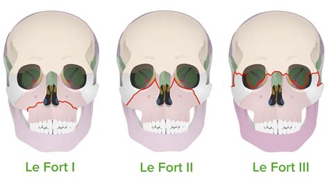 5 LeFort Fracture Types