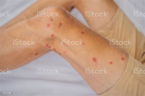 Legs With Many Red Spot And Scar From Insect Bites Mosquitos Allergy Legs With Many Red Spot And Scar From Insect Bites Mosquitos Allergy