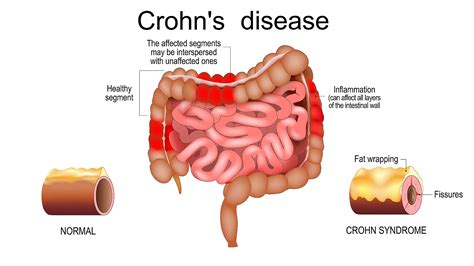 Lesson Biological Medication Use In Crohn S Disease Lesson Biological Medication Use In Crohn S Disease