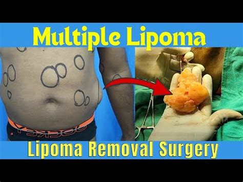 Lipodissolve In Multiple Lipoma Syndrome Youtube