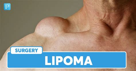 Lipoma Disease Photos