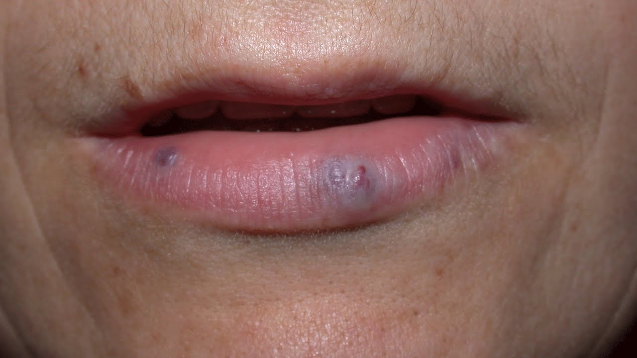 Lips Spots Removal Dark And Sun Spots On Lips