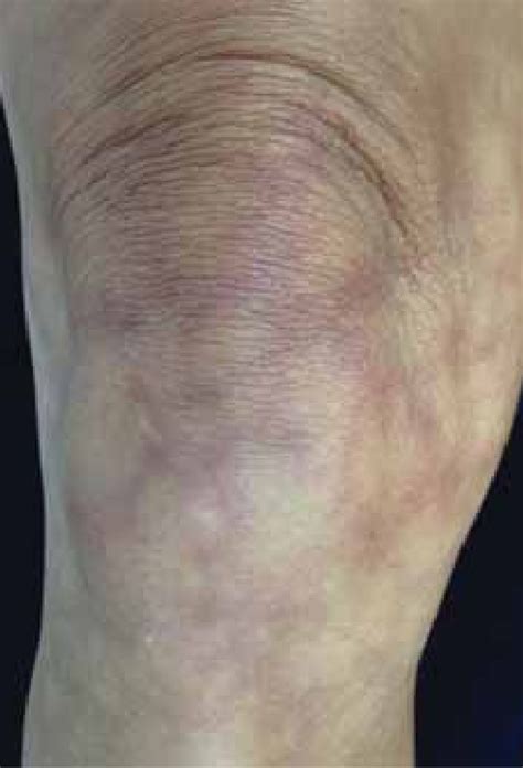 Livedo Reticularis Detail Showing The Lacy Aspect Download Livedo Reticularis Detail Showing The Lacy Aspect Download