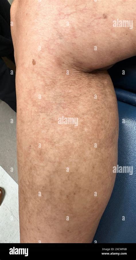 Livedo Reticularis On A Patient S Leg Stock Image M200 0092 Livedo Reticularis On A Patient S Leg Stock Image M200 0092