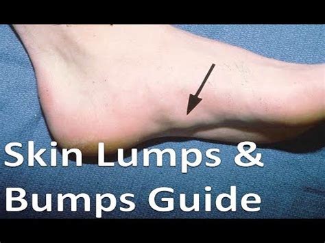 Lumps Bumps On The Foot These Will Shock You Youtube