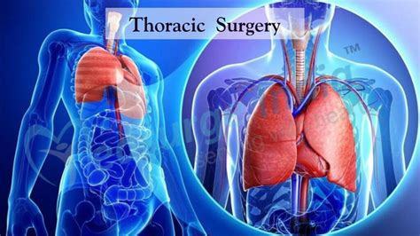 Lung Cancer Newport Cardiac Thoracic Surgery