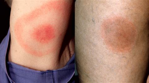 Lyme Disease Bullseye Skin Rash Tick Bite Lyme Warrior Lyme Warrior