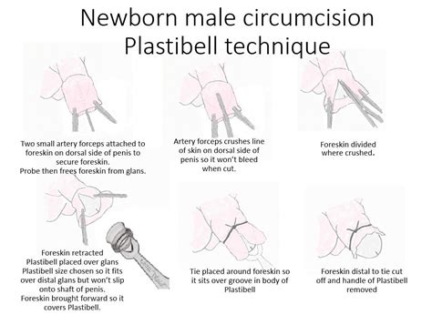Male Circumcision Procedure Male Circumcision Procedure