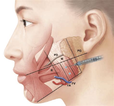 Masseter Muscle Botox Injections The New Clinical Protocol