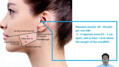 Masseter Muscle Botox