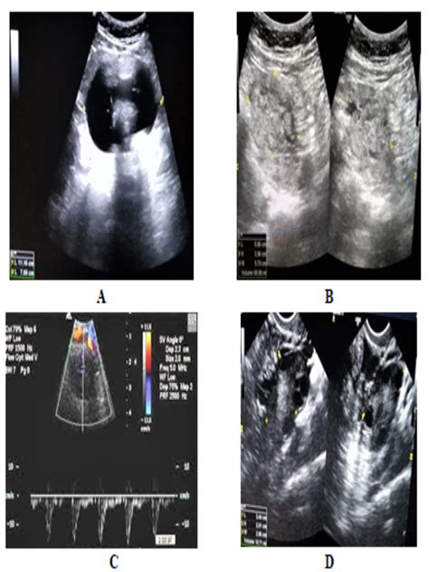 Massive Ovarian Cystic Teratomas Diagnosed At A Rural Nepal Camp Williams 2012 Australasian Journal Of Ultrasound In Medicine Wiley Online Library