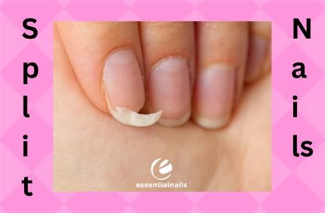 Mastering Nail Split Repairs Essential Nails Mastering Nail Split Repairs Essential Nails