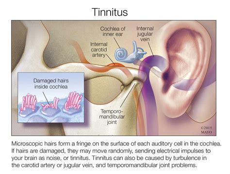 Mayo Clinic Q And A Tinnitus Can Interfere With Hearing But Doesn Amp 39 T