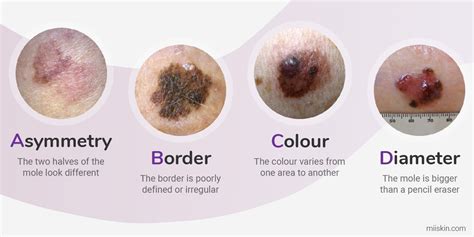 Melanoma Warning Signs And Images