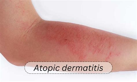 Mild Atopic Dermatitis Legs