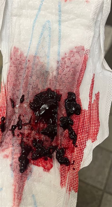 Miscarriage Or Regular Blood Clot Babycenter