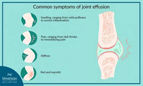 Moderate Joint Effusion