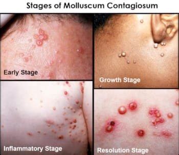 Molluscum Contagiosum Early Stages Otosection Molluscum Contagiosum Early Stages Otosection