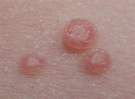 Molluscum Contagiosum Find Out More About This Growing Viral Skin Co Molluscum Contagiosum Find Out More About This Growing Viral Skin Co