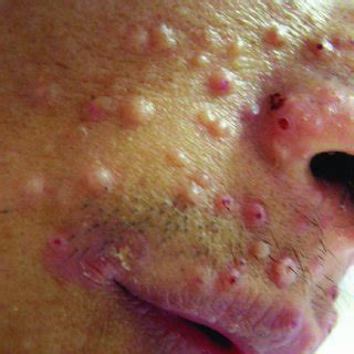 Molluscum Contagiosum Like Skin Lesions Associated With P Marneffei Molluscum Contagiosum Like Skin Lesions Associated With P Marneffei