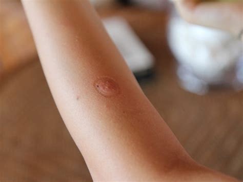 Mosquito Bites Gadget Business Insider