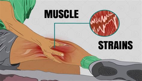 Muscle Strains Causes Symptoms Treatment Recovery Muscle Strains Causes Symptoms Treatment Recovery