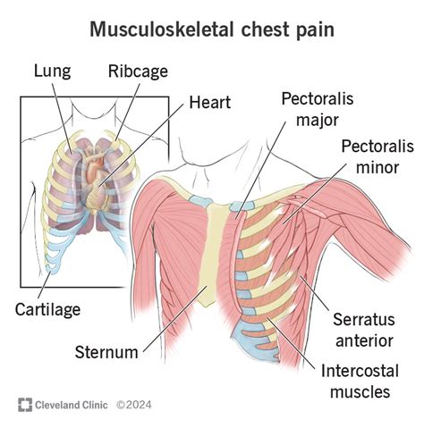 Musculoskeletal Chest Pain