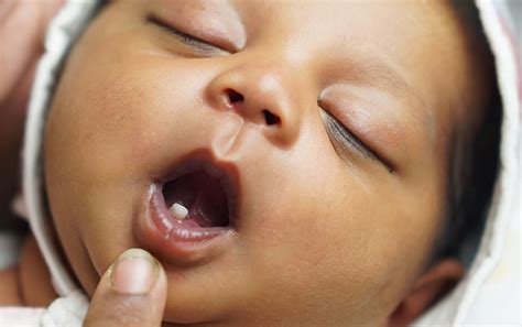 Neonatal Teeth Beverly Hills Ca Kusp Pediatric Dentistry