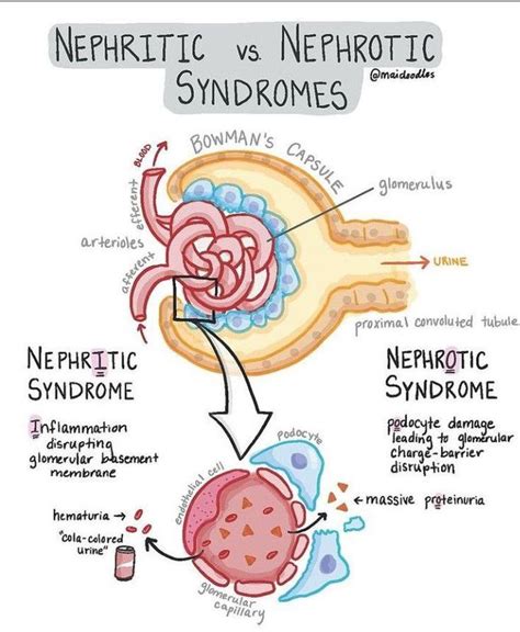 Nephritic Vs Nephrotic Syndrome Medizzy