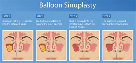 New Sinuplasty Surgery Uses Sinus Balloon To Treat Chronic Sinus Infections New Sinuplasty Surgery Uses Sinus Balloon To Treat Chronic Sinus Infections